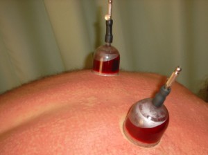 Blood cupping